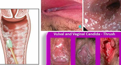 طول دوره درمان عفونت قارچی واژن